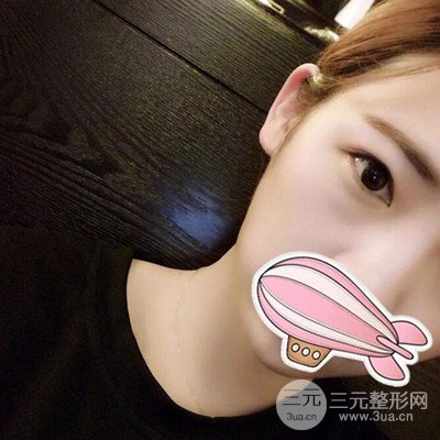 成都素美楊迪雙眼皮案例前后對比照分享~