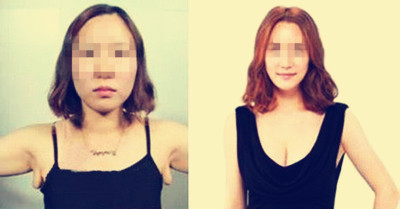 做副乳手術(shù)需要多少錢價格 副乳切除手術(shù)后果對比照片圖