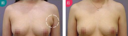 做副乳手術(shù)需要多少錢價格 副乳切除手術(shù)后果對比照片圖