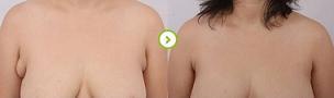 做副乳手術(shù)需要多少錢價格 副乳切除手術(shù)后果對比照片圖