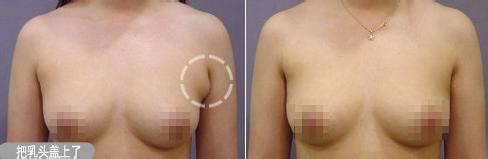 做副乳手術(shù)需要多少錢價格 副乳切除手術(shù)后果對比照片圖