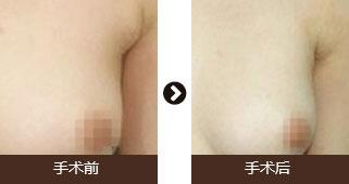做副乳手術(shù)需要多少錢價格 副乳切除手術(shù)后果對比照片圖