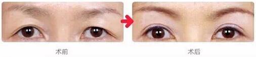 切眉術(shù)有哪些注意事項(xiàng) 切眉術(shù)前后對(duì)比圖