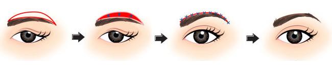 做切眉術降低風險嗎 切眉術風險大不大