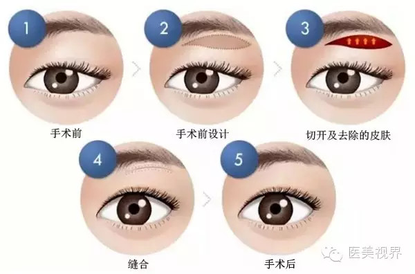 做切眉術降低風險嗎 切眉術風險大不大