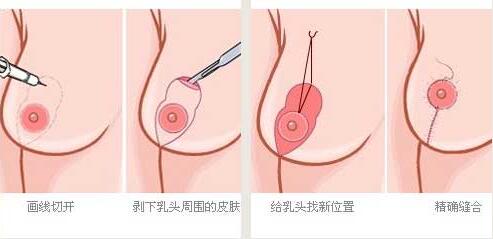 乳房下垂矯正手術(shù)后會(huì)再松弛嗎