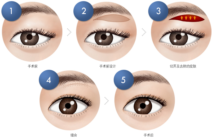 切眉術(shù)后如何快速消腫