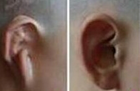 選擇隱耳整形有什么優(yōu)勢(shì)呢？