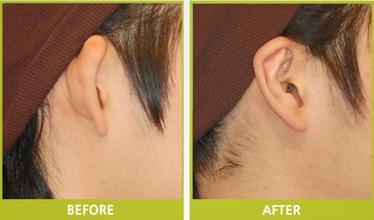 招風耳矯正,術(shù)后,多久,可能,恢復