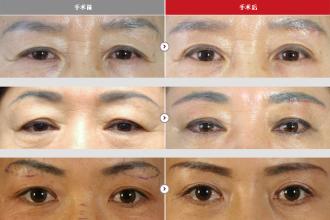 眉毛整形果圖
