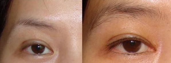 眉毛整形對(duì)比果照片圖