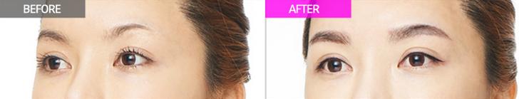 眉毛整形對(duì)比果照片圖
