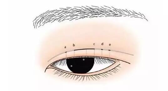 雙眼皮手術(shù),幾天,可以上班,有什么,注意事項(xiàng)