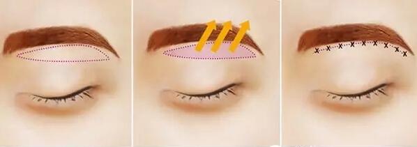 切眉手術(shù)前后對比照片
