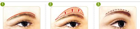切眉手術(shù)前后對比照片