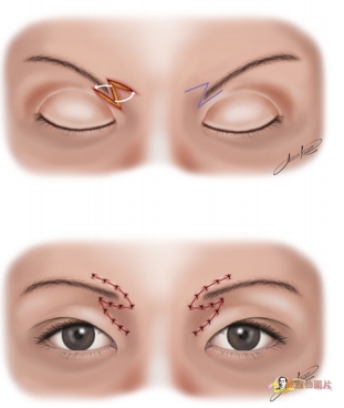 切眉手術(shù)前后對比照片