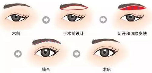 切眉術(shù)手術(shù)過程