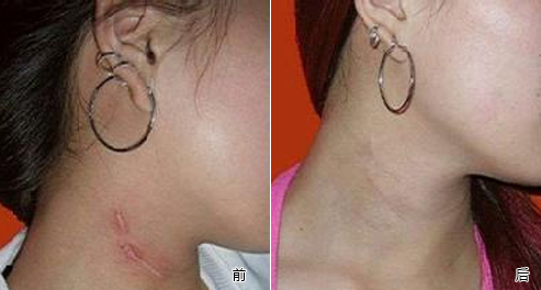 佛山,疤痕,修復(fù),大概,多少錢