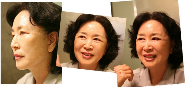 拉皮除皺手術(shù)讓我年輕20歲