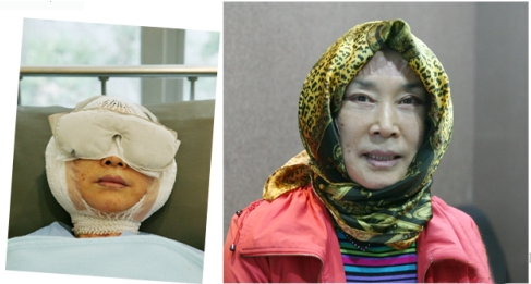 拉皮除皺手術(shù)讓我年輕20歲