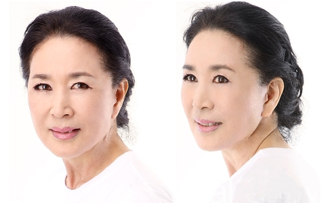 拉皮除皺手術(shù)讓我年輕20歲