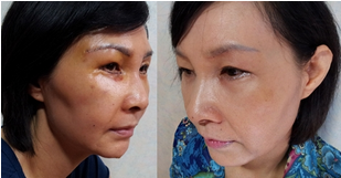 做了電波l皮除皺年輕了十多歲 杭州同欣做的很不錯(cuò)哦