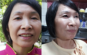 做了電波l皮除皺年輕了十多歲 杭州同欣做的很不錯(cuò)哦