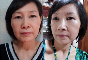 做了電波l皮除皺年輕了十多歲 杭州同欣做的很不錯(cuò)哦