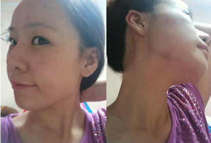 為大家分享我在北京301醫(yī)院做下頜角整形的真實歷程