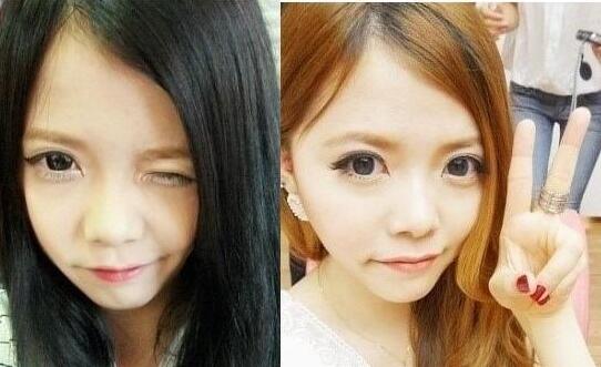 硅膠隆鼻手術(shù)圓了我高鼻梁的夢(mèng)