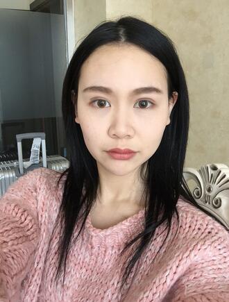 成都天使之翼做隆鼻整形改變了我的塌鼻子 果真的很不錯
