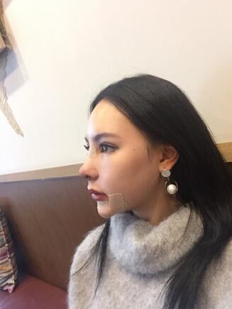 成都天使之翼做隆鼻整形改變了我的塌鼻子 果真的很不錯