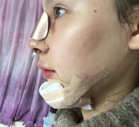 成都天使之翼做隆鼻整形改變了我的塌鼻子 果真的很不錯