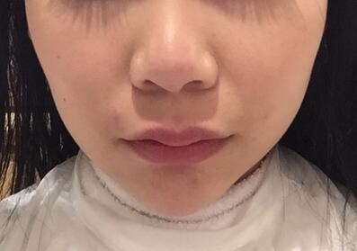 成都天使之翼做隆鼻整形改變了我的塌鼻子 果真的很不錯