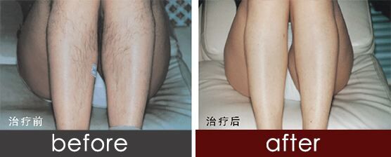 佛山激光脫毛大概多少錢、激光脫毛價格表曝出