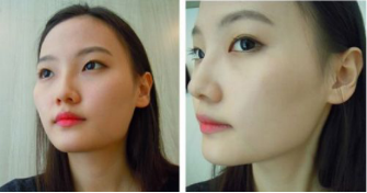 和大家分享北京301醫(yī)院做的下頜角整形真實經(jīng)