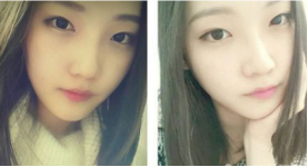 和大家分享北京301醫(yī)院做的下頜角整形真實經(jīng)