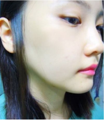 和大家分享北京301醫(yī)院做的下頜角整形真實經(jīng)