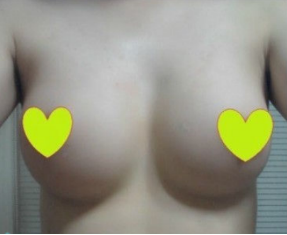 假體隆胸讓我告別小平胸 感謝北京彤美