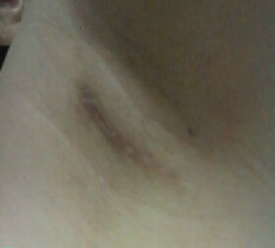 假體隆胸讓我告別小平胸 感謝北京彤美