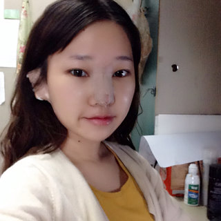耳軟骨隆鼻改變了我的塌鼻梁 北京彤美做的果很棒