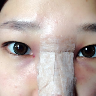 耳軟骨隆鼻改變了我的塌鼻梁 北京彤美做的果很棒