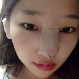 耳軟骨隆鼻改變了我的塌鼻梁 北京彤美做的果很棒