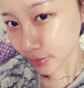 顴骨整形后我也變得甜美了