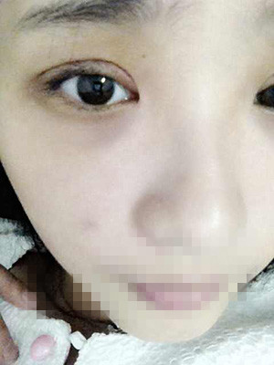 割雙眼皮恢復(fù)過程圖