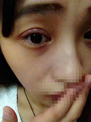 割雙眼皮恢復(fù)過程圖