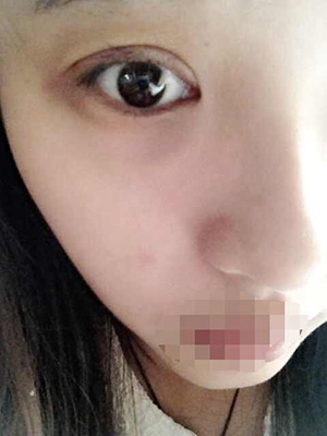 割雙眼皮恢復(fù)過程圖