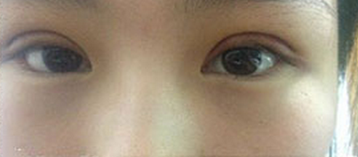 全切雙眼皮十天啦~來看看我的果