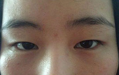 全切雙眼皮十天啦~來看看我的果