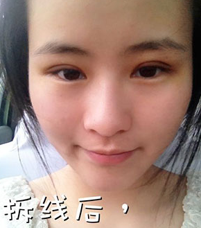 全切雙眼皮十天啦~來看看我的果